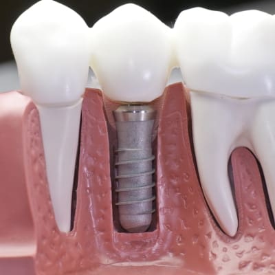 Dental Implants