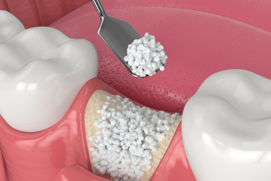 Dental Bone Grafts