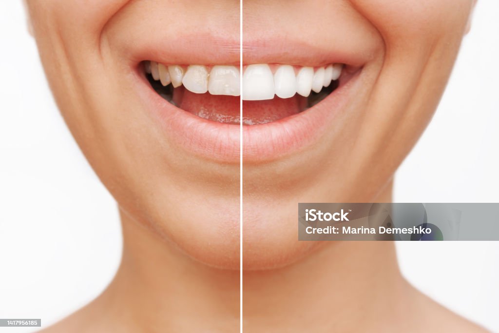 Dental Veneers